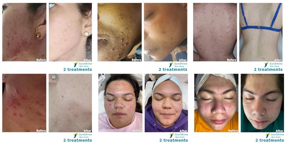 Bio-Microneedling - Cosmedics-Skin